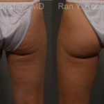 Coolsculpting Elite Before and After Photos in Montvale, NJ, Patient 12424