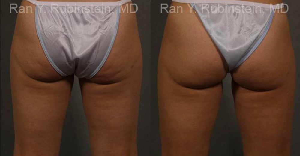 Coolsculpting Elite Before and After Photos in Montvale, NJ, Patient 12424