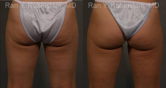 Coolsculpting Elite Before and After Photos in Montvale, NJ, Patient 12424