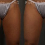Coolsculpting Elite Before and After Photos in Montvale, NJ, Patient 12424