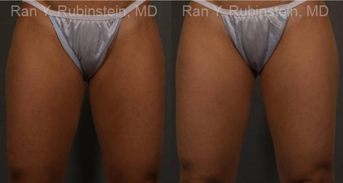 Coolsculpting Elite Before and After Photos in Montvale, NJ, Patient 12424