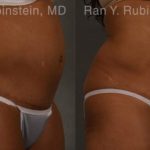Coolsculpting Elite Before and After Photos in Montvale, NJ, Patient 12429