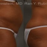 Coolsculpting Elite Before and After Photos in Montvale, NJ, Patient 12429