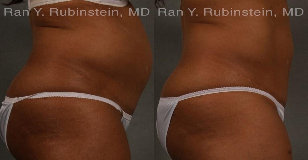 Coolsculpting Elite Before and After Photos in Montvale, NJ, Patient 12429