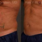 Coolsculpting Elite Before and After Photos in Montvale, NJ, Patient 12434