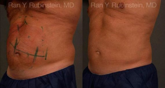 Coolsculpting Elite Before and After Photos in Montvale, NJ, Patient 12434