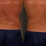 Coolsculpting Elite Before and After Photos in Montvale, NJ, Patient 12434