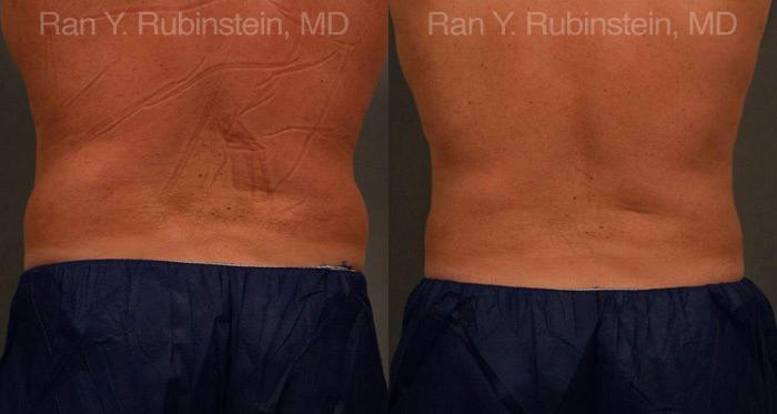 Coolsculpting Elite Before and After Photos in Montvale, NJ, Patient 12434