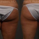 Coolsculpting Elite Before and After Photos in Montvale, NJ, Patient 12439