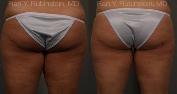 Coolsculpting Elite Before and After Photos in Montvale, NJ, Patient 12439