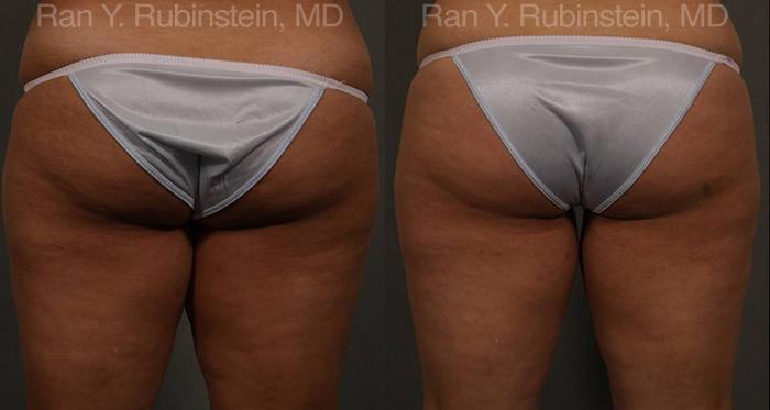 Coolsculpting Elite Before and After Photos in Montvale, NJ, Patient 12439