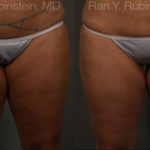 Coolsculpting Elite Before and After Photos in Montvale, NJ, Patient 12439
