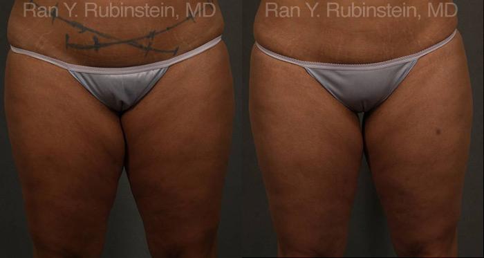 Coolsculpting Elite Before and After Photos in Montvale, NJ, Patient 12439