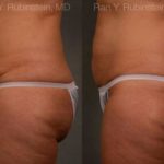 Coolsculpting Elite Before and After Photos in Montvale, NJ, Patient 12444