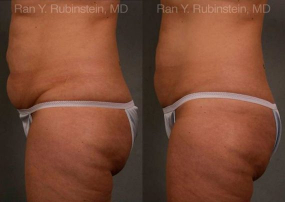 Coolsculpting Elite Before and After Photos in Montvale, NJ, Patient 12444