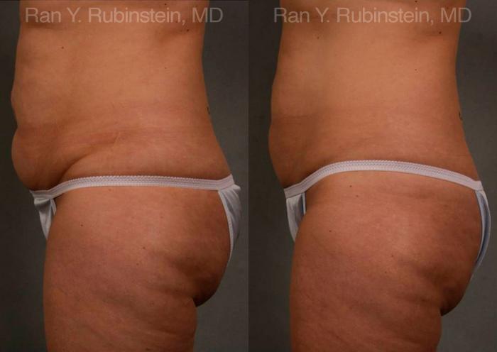 Coolsculpting Elite Before and After Photos in Montvale, NJ, Patient 12444
