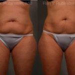 Coolsculpting Elite Before and After Photos in Montvale, NJ, Patient 12444