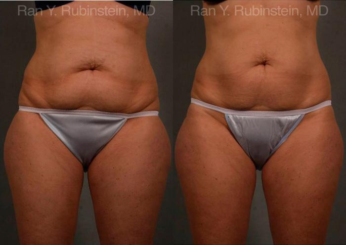 Coolsculpting Elite Before and After Photos in Montvale, NJ, Patient 12444