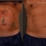 Coolsculpting Elite Before and After Photos in Montvale, NJ, Patient 12449