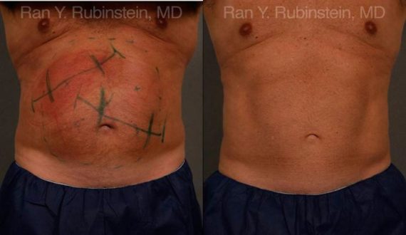 Coolsculpting Elite Before and After Photos in Montvale, NJ, Patient 12449