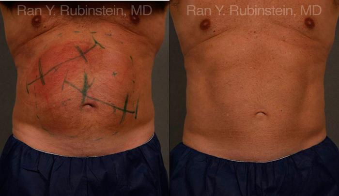 Coolsculpting Elite Before and After Photos in Montvale, NJ, Patient 12449