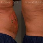 Coolsculpting Elite Before and After Photos in Montvale, NJ, Patient 12449