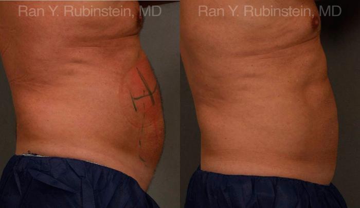Coolsculpting Elite Before and After Photos in Montvale, NJ, Patient 12449
