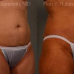 Coolsculpting Elite Before and After Photos in Montvale, NJ, Patient 12454