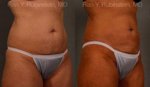 Coolsculpting Elite Before and After Photos in Montvale, NJ, Patient 12454