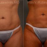 Coolsculpting Elite Before and After Photos in Montvale, NJ, Patient 12454