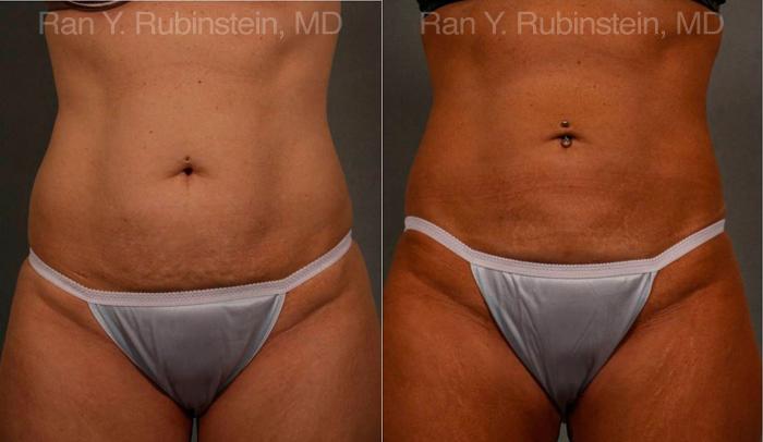 Coolsculpting Elite Before and After Photos in Montvale, NJ, Patient 12454