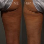 Coolsculpting Elite Before and After Photos in Montvale, NJ, Patient 12459