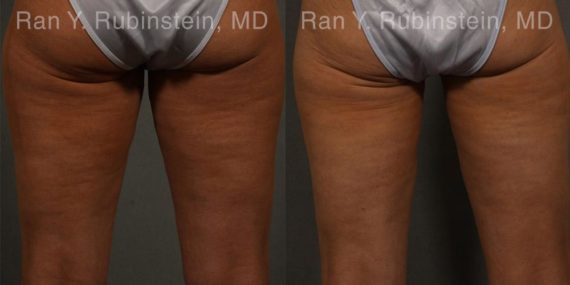 Coolsculpting Elite Before and After Photos in Montvale, NJ, Patient 12459