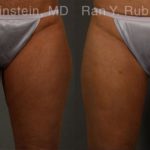 Coolsculpting Elite Before and After Photos in Montvale, NJ, Patient 12459