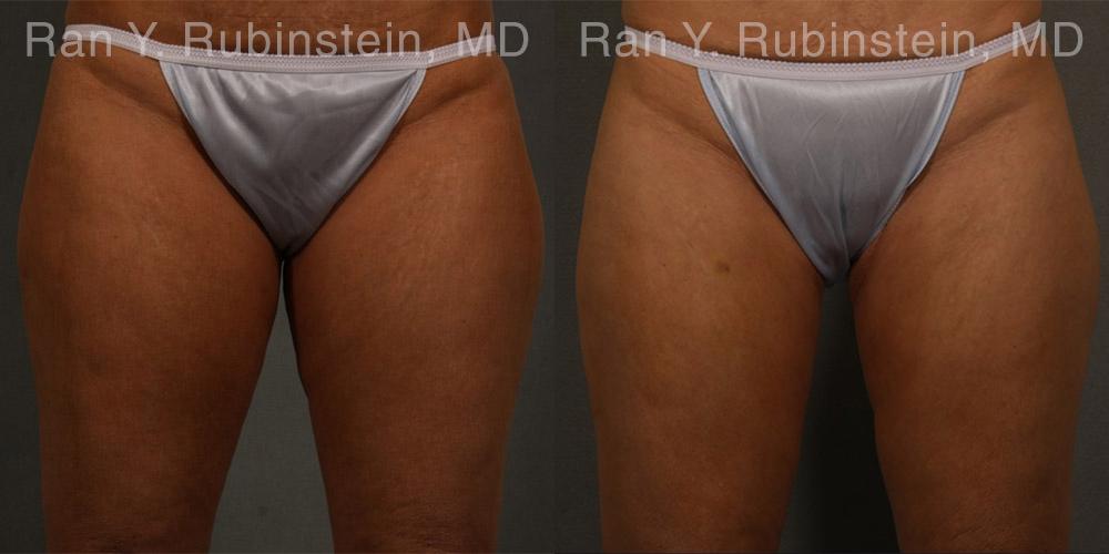 Coolsculpting Elite Before and After Photos in Montvale, NJ, Patient 12459