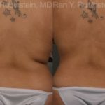 Coolsculpting Elite Before and After Photos in Montvale, NJ, Patient 12464