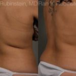 Coolsculpting Elite Before and After Photos in Montvale, NJ, Patient 12464