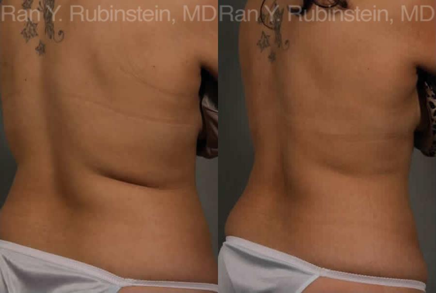 Coolsculpting Elite Before and After Photos in Montvale, NJ, Patient 12464