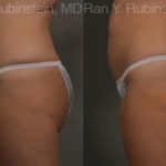 Coolsculpting Elite Before and After Photos in Montvale, NJ, Patient 12469