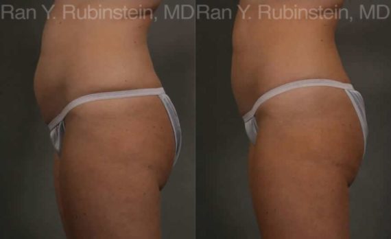Coolsculpting Elite Before and After Photos in Montvale, NJ, Patient 12469