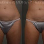 Coolsculpting Elite Before and After Photos in Montvale, NJ, Patient 12469