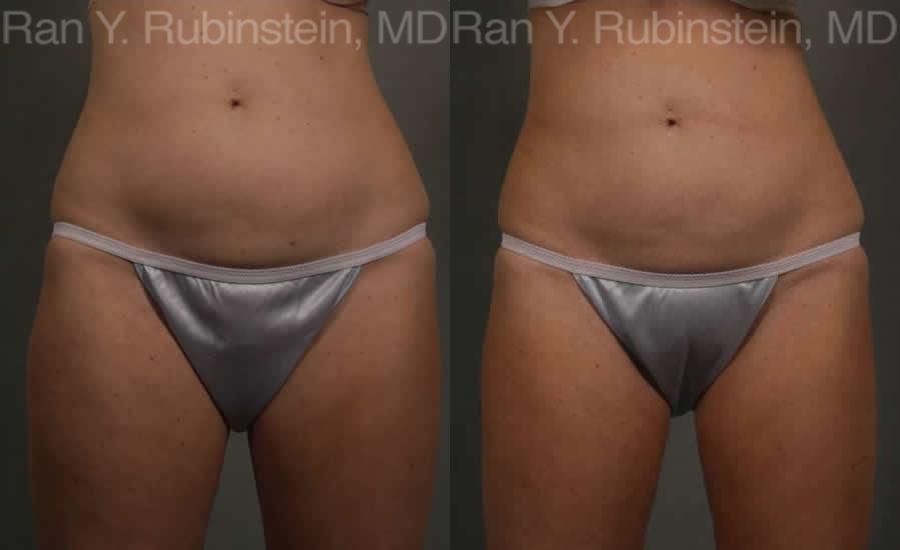 Coolsculpting Elite Before and After Photos in Montvale, NJ, Patient 12469