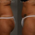 Coolsculpting Elite Before and After Photos in Montvale, NJ, Patient 12474