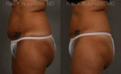 Coolsculpting Elite Before and After Photos in Montvale, NJ, Patient 12474