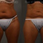 Coolsculpting Elite Before and After Photos in Montvale, NJ, Patient 12474