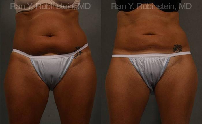 Coolsculpting Elite Before and After Photos in Montvale, NJ, Patient 12474