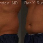 Coolsculpting Elite Before and After Photos in Montvale, NJ, Patient 12479