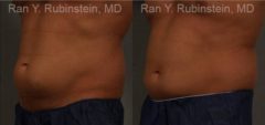Coolsculpting Elite Before and After Photos in Montvale, NJ, Patient 12479