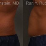 Coolsculpting Elite Before and After Photos in Montvale, NJ, Patient 12479