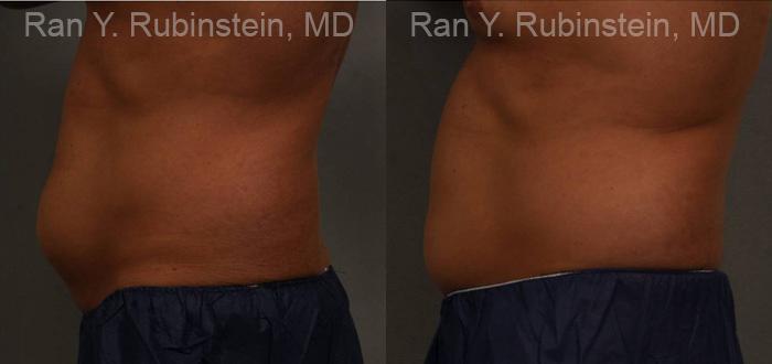 Coolsculpting Elite Before and After Photos in Montvale, NJ, Patient 12479